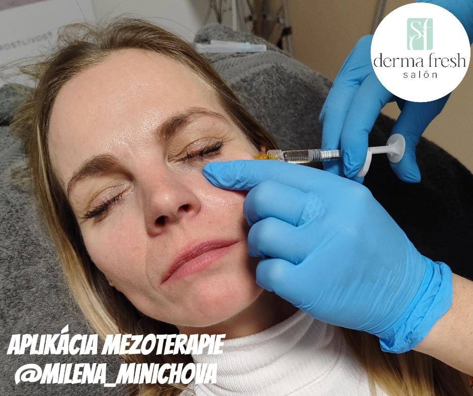 Mezoterapia - Milena Minichová