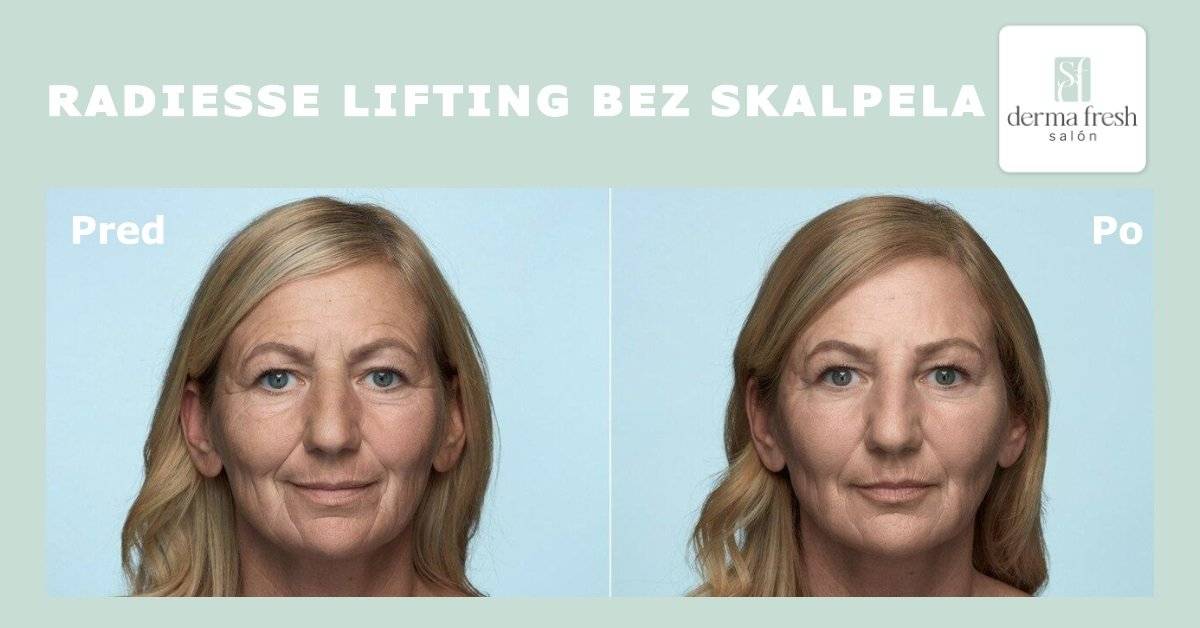 radiesse vyplne pred a po