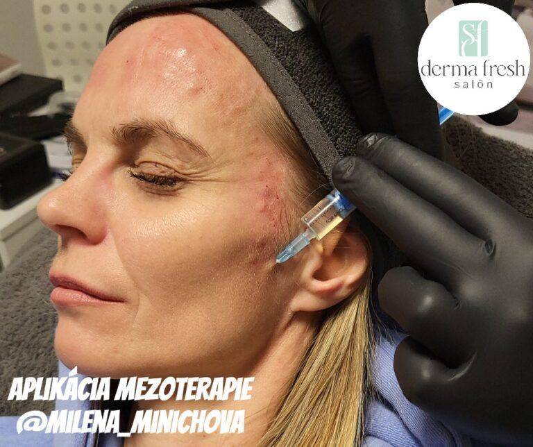 Mezoterapia aplikacia - Milena Minichova