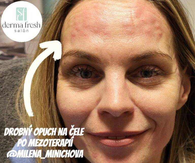 Drobny opuch po mezoterapii - Milena Minichova