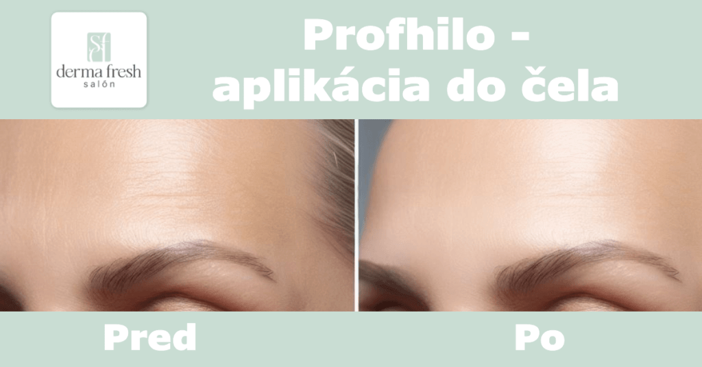 Profhilo pred a po