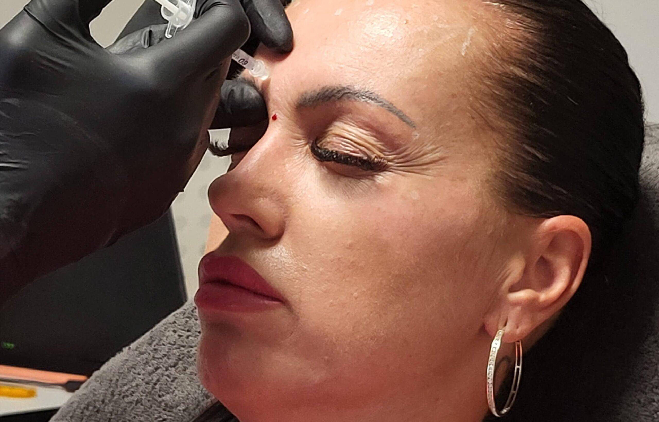 Botox: Ako dlho pôsobí jeho omladzujúci účinok?