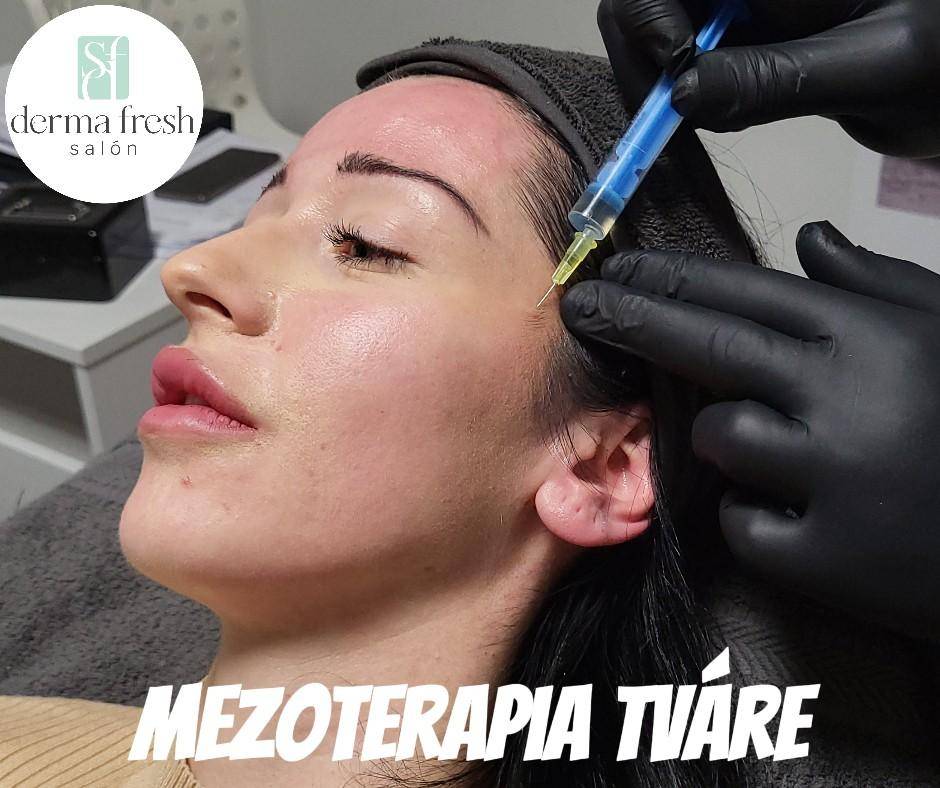 Mezoterapia tváre