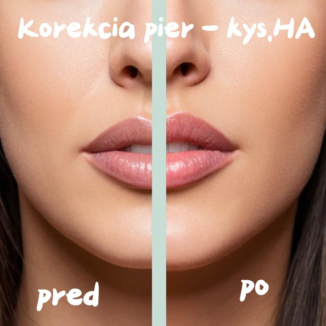 Korekcia pier kyselinou HA