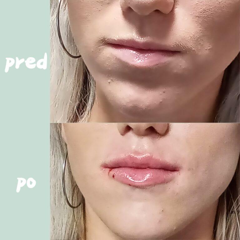 Druha klientka zvacsenie pier pred a po