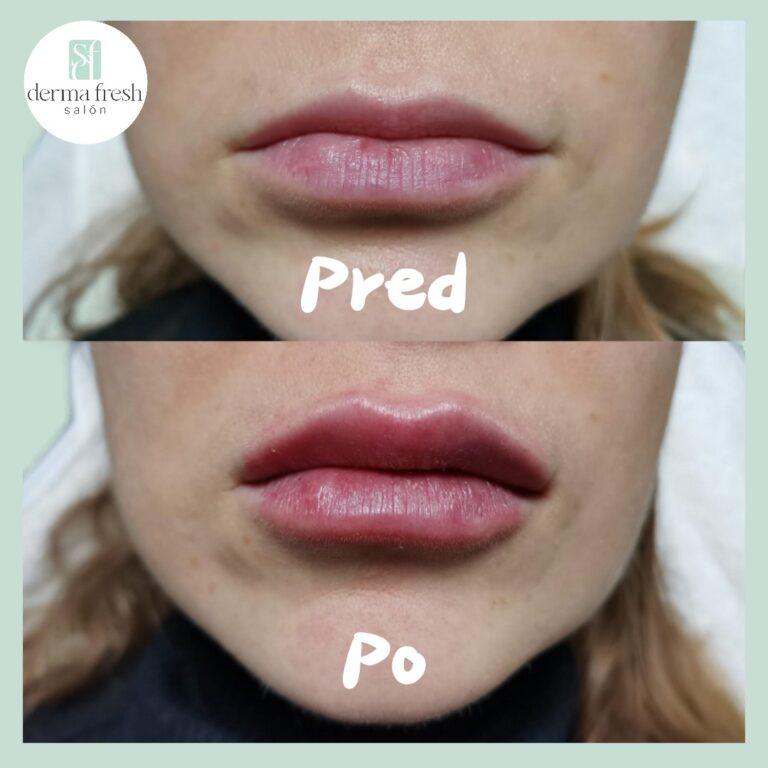 Klientka - zvacsenie pier pred a po