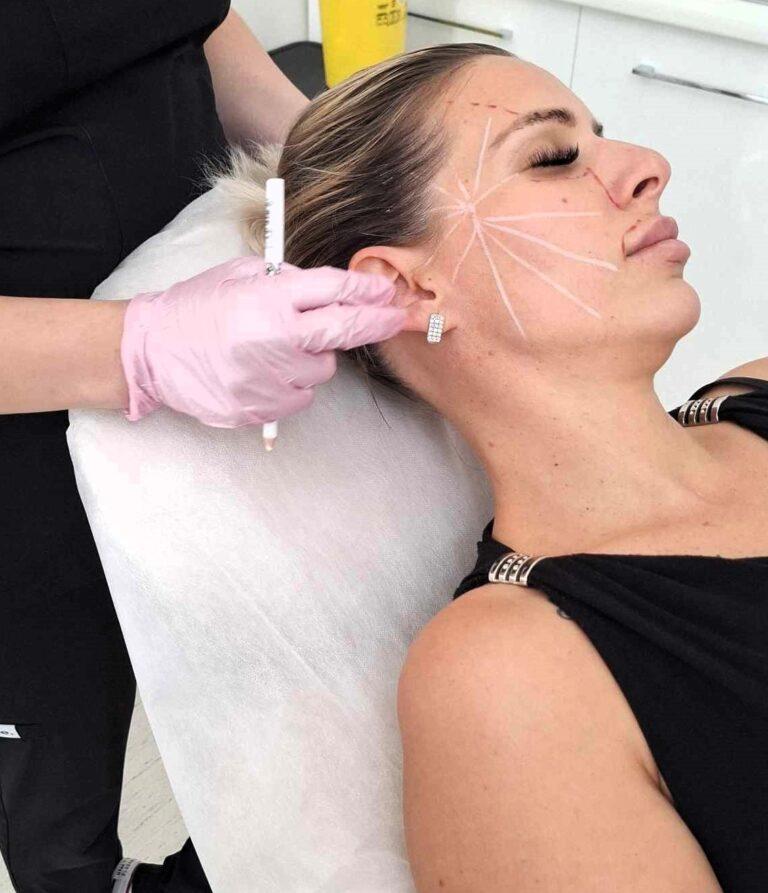 Sculptra aplikácia proti vráskam