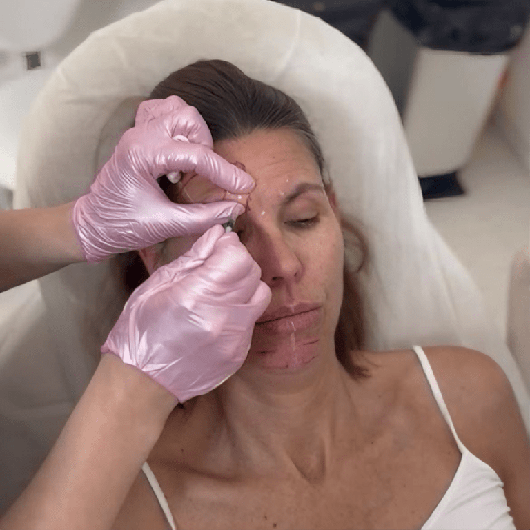 Sculptra aplikacia klientke