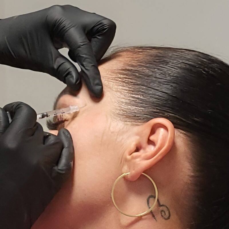 Botox aplikacia ihlou