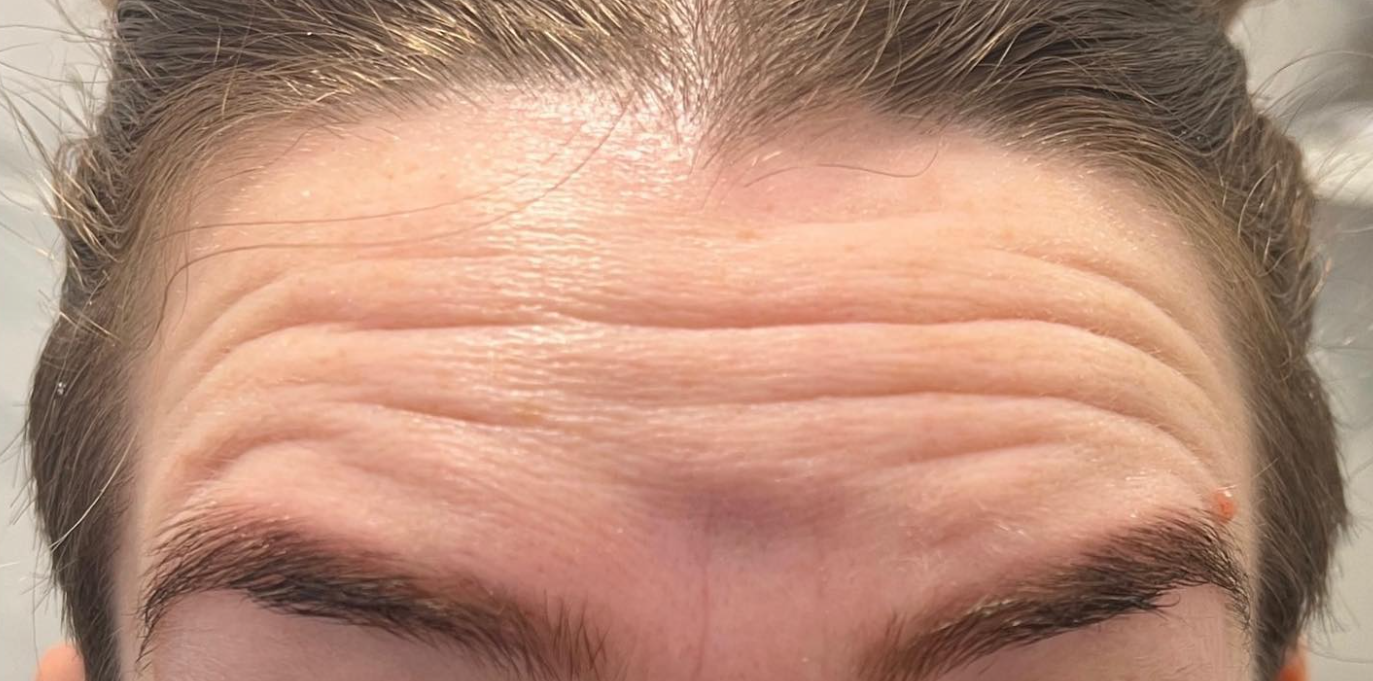 Pred ošetrením Botox