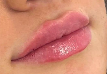 Po zväčšení pier