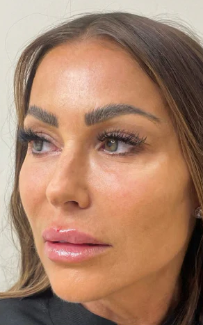 Po ošetrení Polynukleotidmi