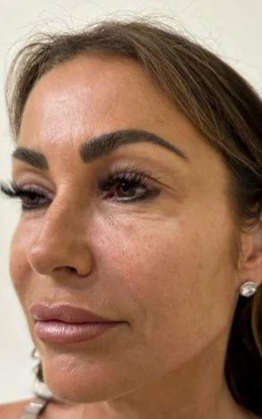 Pred ošetrením Polynukleotidmi