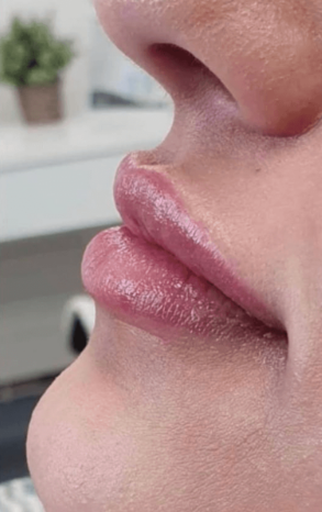 Po zväčšení pier