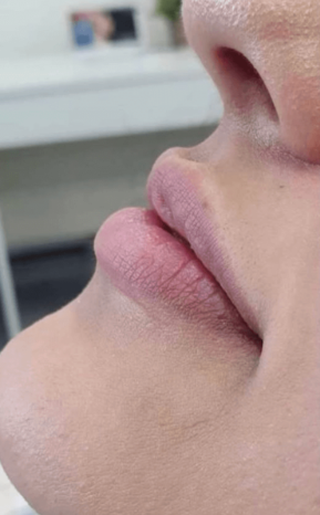 Pred zväčšením pier